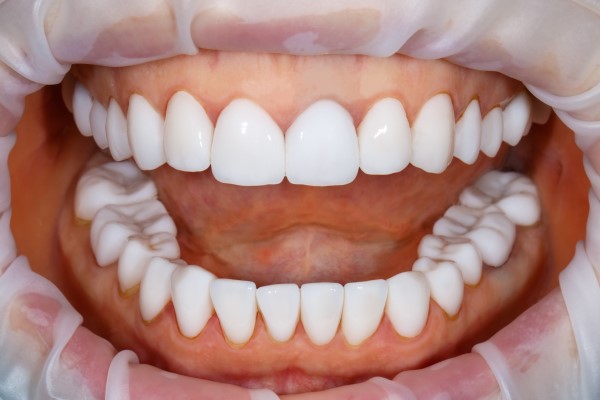 Transforming Your Smile: Steps To A Successful Smile Makeover